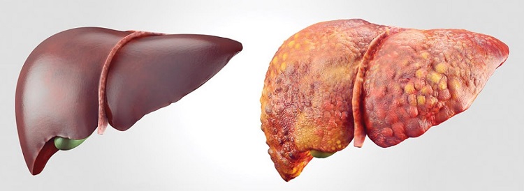 A diferença entre o fígado normal (esquerda) e um com cirrose (direita) é a modificação do tecido hepático