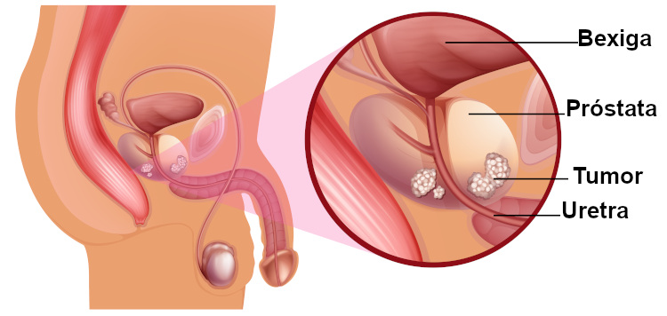  A ilustração acima representa o desenvolvimento de um tumor na região da próstata.