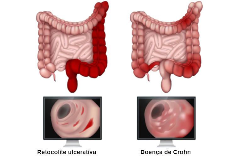  A retocolite ulcerativa e a doença de Crohn podem apresentar sintomas semelhantes, porém as duas doenças têm diferenças marcantes.