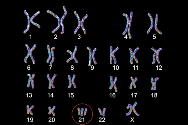 O indivíduo com síndrome de Down possui um cromossomo 21 extra.