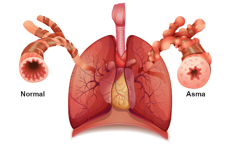 A asma provoca o estreitamento das vias respiratórias, o que causa sintomas como tosse e falta de ar.