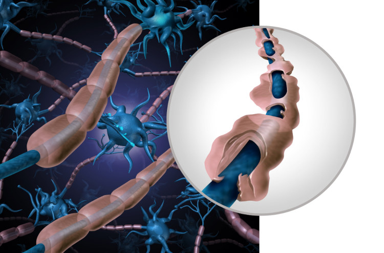Na esclerose múltipla, observa-se um processo de desmielinização, ou seja, de destruição da mielina.