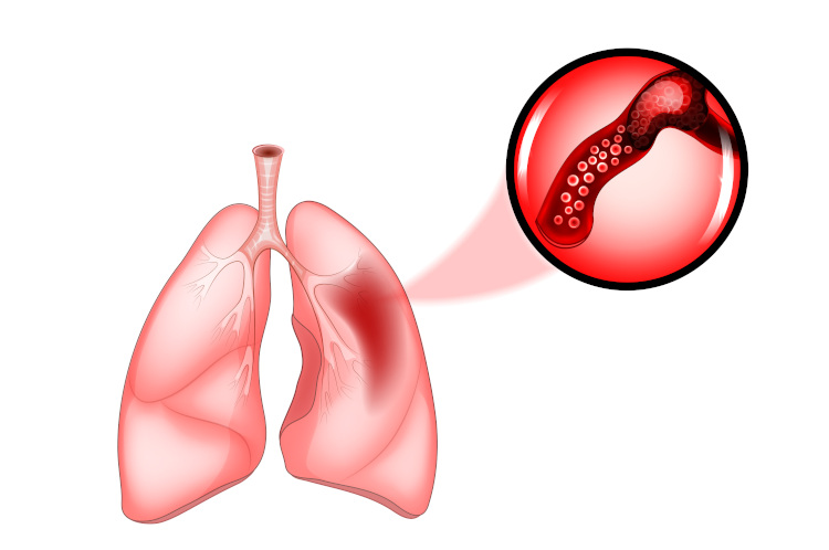 A embolia pulmonar pode ser fatal e se caracteriza pela presença de trombos na artéria pulmonar ou em um de seus ramos.