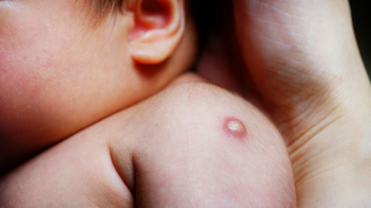 Foto de um recém-nascido com foco no sinal formado pela vacina BCG em seu braço.