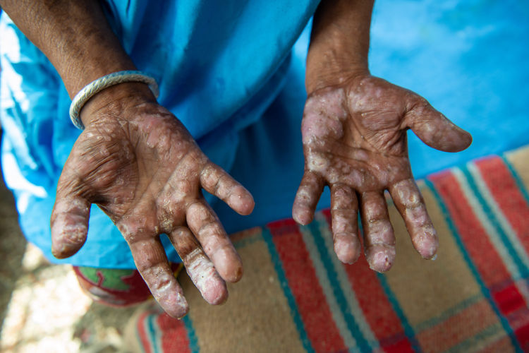 Detalhe da mão de uma pessoa com hanseníase em Nova Deli. [1]