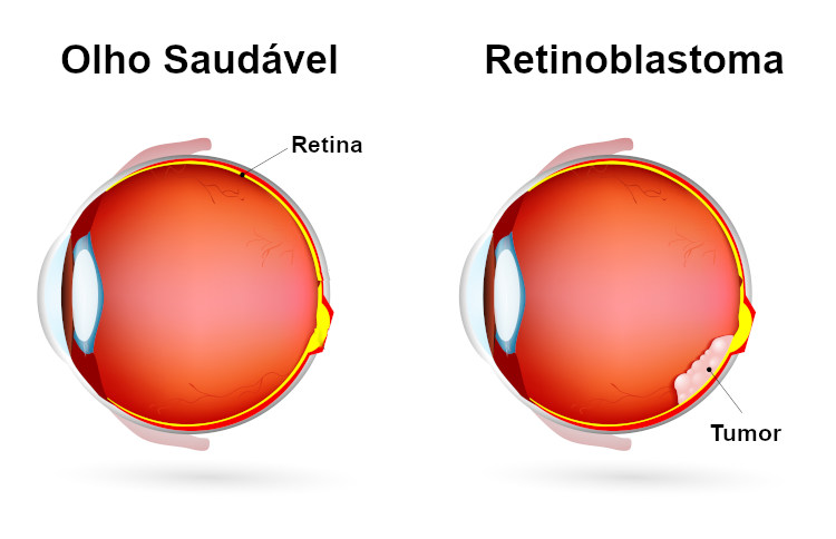 Ilustração de olho normal e olho com retinoblastoma