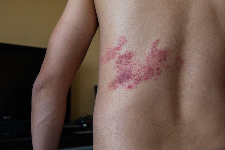 Pele humana das costas infectada com herpes-zóster