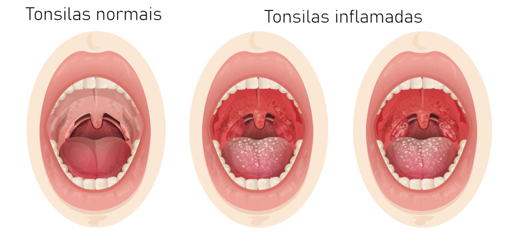Ilustração da forma como ficam as tonsilas (amígdalas) normais e inflamadas.