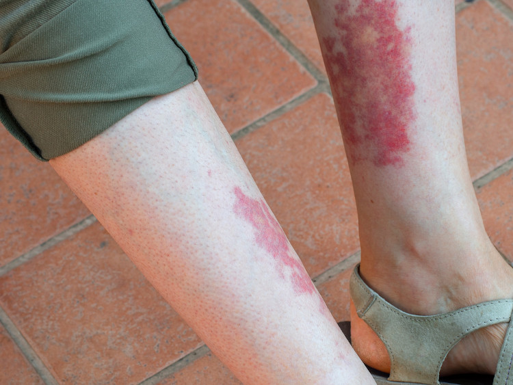Manchas vermelhas na pele de uma pessoa, um sintoma de vasculite (inflamação dos vasos sanguíneos).