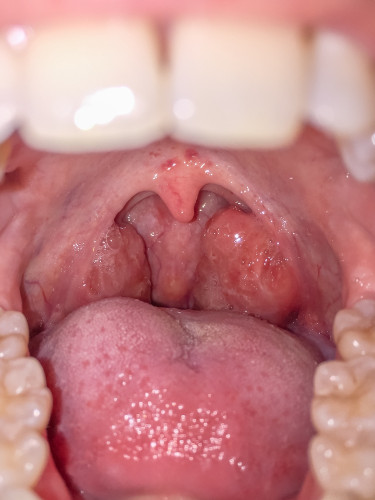 Boca aberta com vista das amígdalas aumentadas e avermelhadas, alguns dos sintomas da amigdalite.