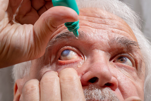Homem fazendo uso de colírio, uma das formas de tratamento do glaucoma.