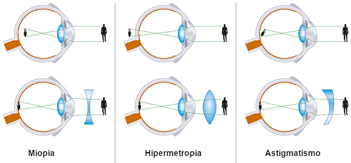 Ilustração da formação da imagem no olho humano em casos de miopia, hipermetropia e astigmatismo.