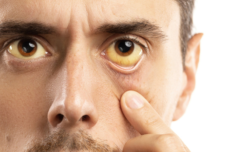 Olhos com coloração amarelada, característica da icterícia, um problema no fluxo da bile.