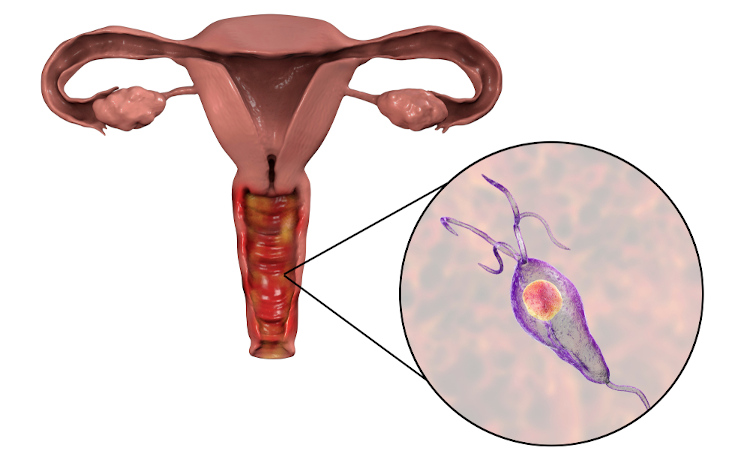  Ilustração dos órgãos reprodutores femininos e, em destaque, o protozoário causador da tricomoníase.