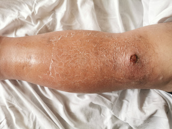Lesões, inchaço e descamação da pele provocados pela erisipela.