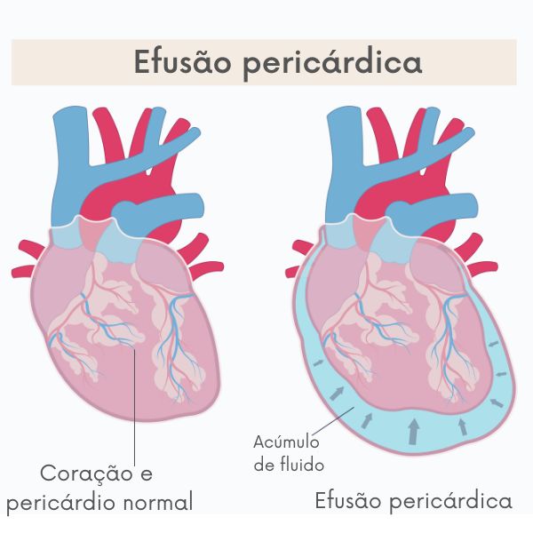 Representação de coração normal e de coração com derrame pericárdico.