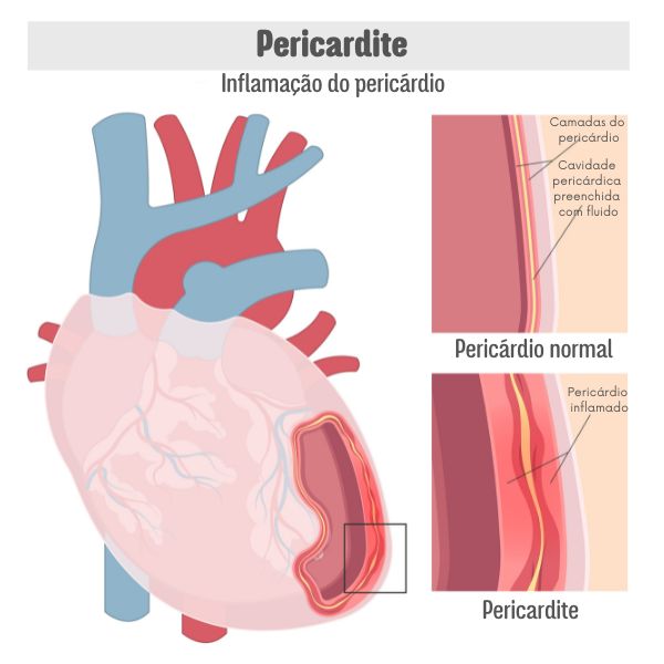 Representação de coração humano acometido por pericardite