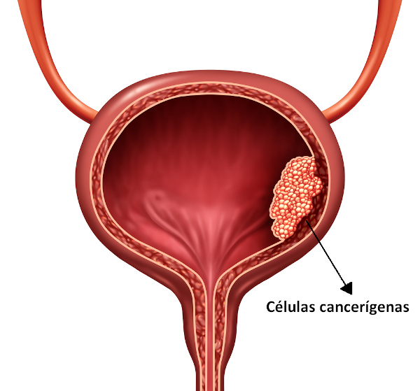 Ilustração mostrando a proliferação de células cancerígenas na bexiga urinária (câncer de bexiga).