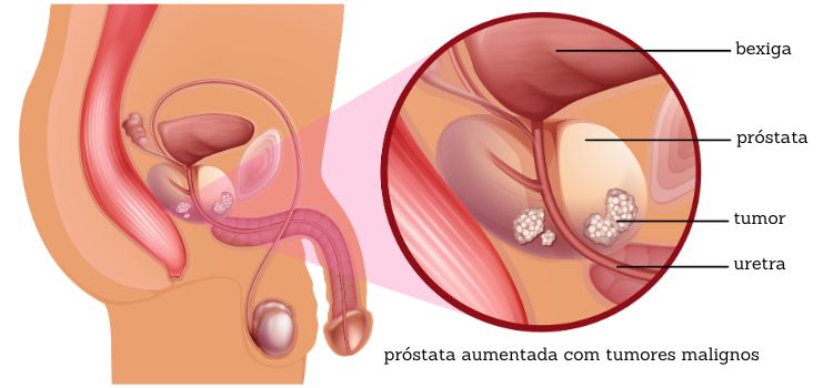Ilustração mostrando o câncer de próstata, uma das doenças que acometem o sistema reprodutor masculino.