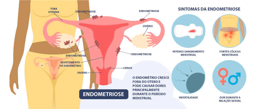  Ilustração mostrando detalhes sobre a endometriose, uma das doenças que acometem o sistema reprodutor feminino.