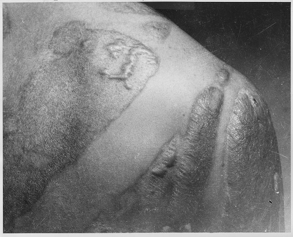 Efeitos da radiação na pele de um sobrevivente à bomba atômica de Hiroshima.