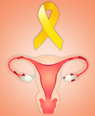 A endometriose pode levar à infertilidade