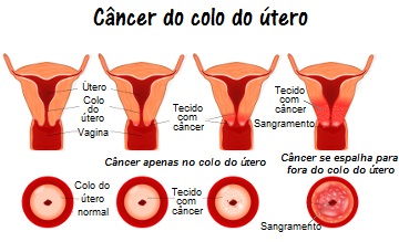 Observe a evolução do câncer do colo do útero