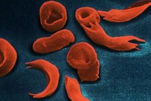 Pessoas com anemia falciforme possuem suas hemácias alteradas.