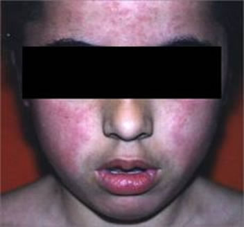 Um dos sintomas da escarlatina é a presença de manchas no rosto