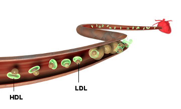 Observe a formação de placas ocasionada pelo LDL