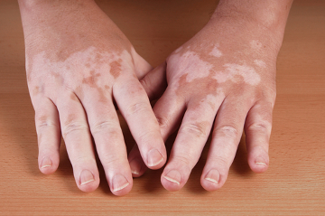 O vitiligo é um exemplo de doença autoimune