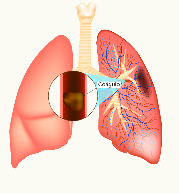 A embolia pulmonar é causada pela obstrução da artéria pulmonar ou de seus ramos.