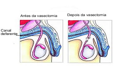 A vasectomia é um procedimento cirúrgico simples que pode ser feito no próprio consultório médico