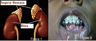 Na figura 1 vemos a localização das glândulas suprarrenais; e na figura 2 podemos observar a hiperpigmentação da gengiva, um sintoma típico da doença 