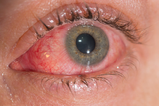 A conjuntivite é uma inflamação na membrana que recobre o olho
