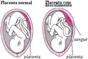 As diferenças entre a placenta normal e a que apresenta descolamento.