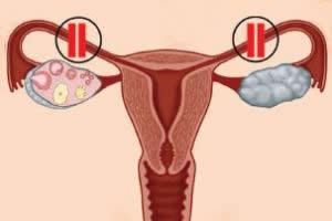 A laqueadura promove o isolamento das tubas uterinas, impedindo o encontro entre os gametas