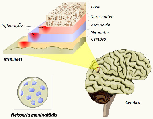 As meninges são as membranas que revestem o sistema nervoso central. Sua inflamação recebe o nome de meningite