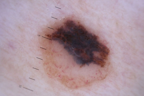 O melanoma é um tipo grave de câncer de pele e apresenta alta letalidade.