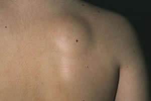 Lipomas se apresentam como lesões arredondadas e palpáveis.