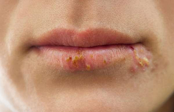 A herpes labial é um tipo de doença viral