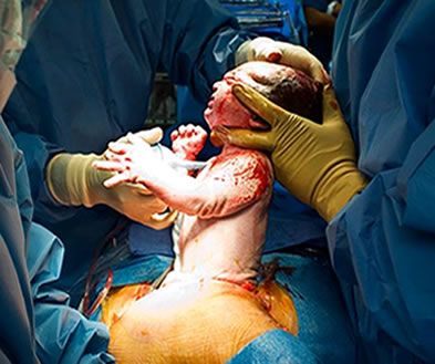 Retirada do bebê da barriga da mãe em um parto cesárea