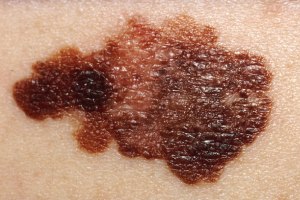 Lesões que apresentam diferenças de tonalidade, além de bordas, podem se tratar de melanomas.